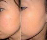 Тональный крем для проблемной кожи CLINIQUE Anti-Blemish Solutions Liquid Makeup фото