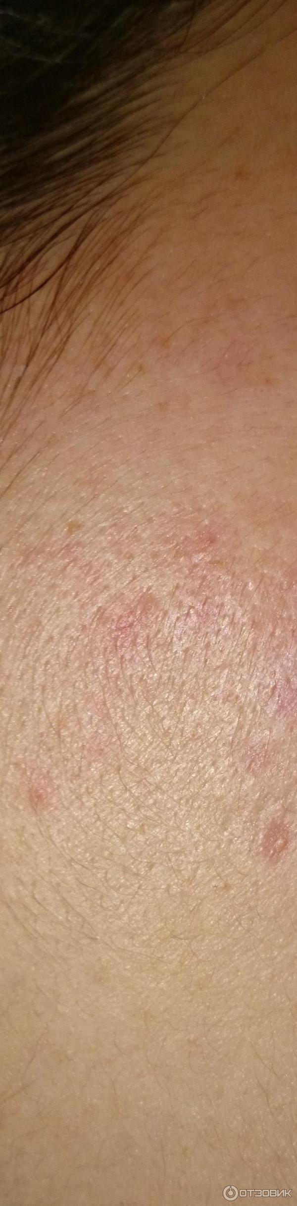 Корректирующее средство локального действия La Roche-Posay Effaclar AI фото