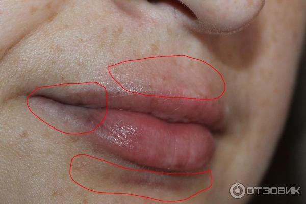 Прибор для увеличения губ Fullips фото