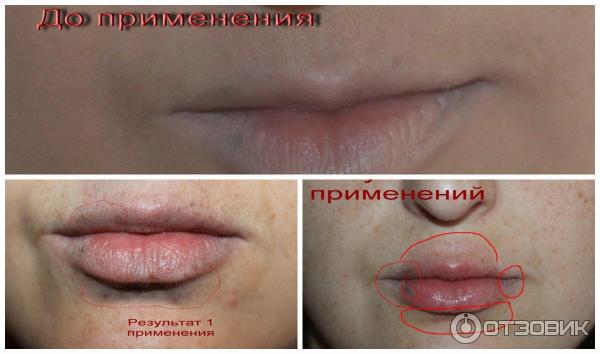 Прибор для увеличения губ Fullips фото