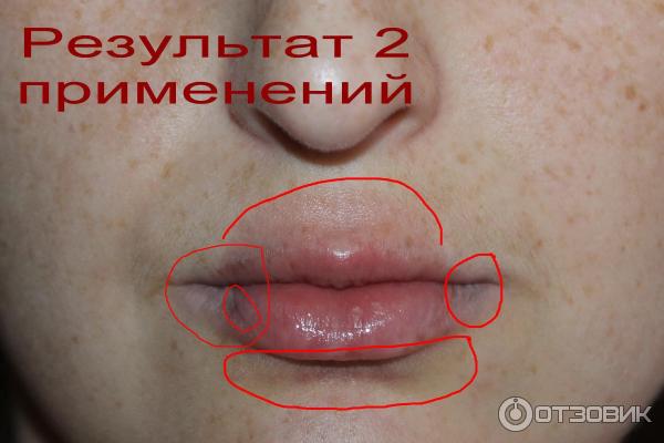 Прибор для увеличения губ Fullips фото