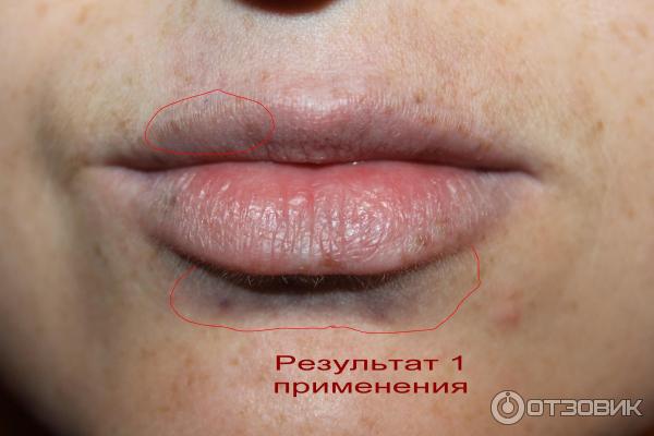 Прибор для увеличения губ Fullips фото