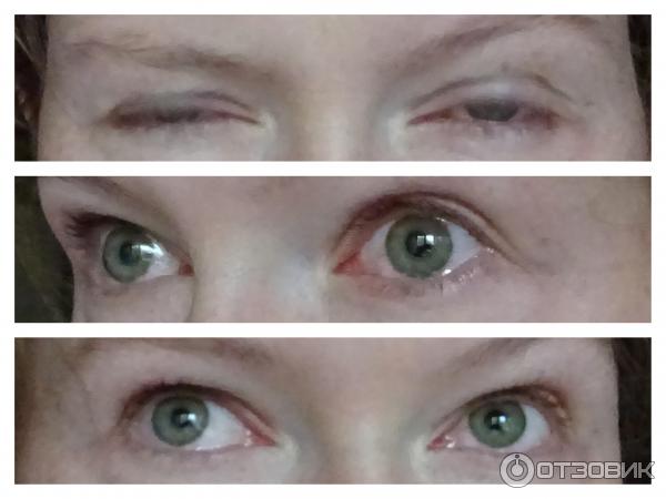 ALMEA XLash, фото на ресницах, слезы, побочки