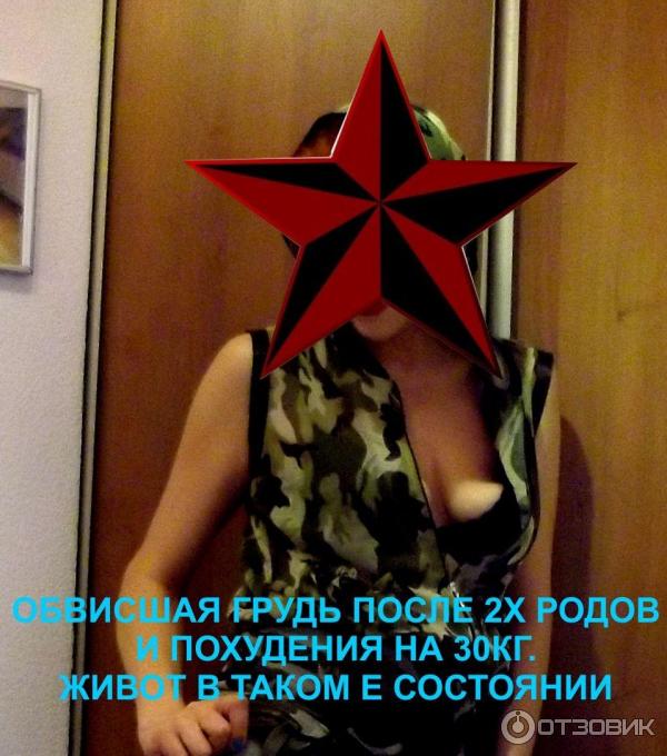 Абдоминопластика фото