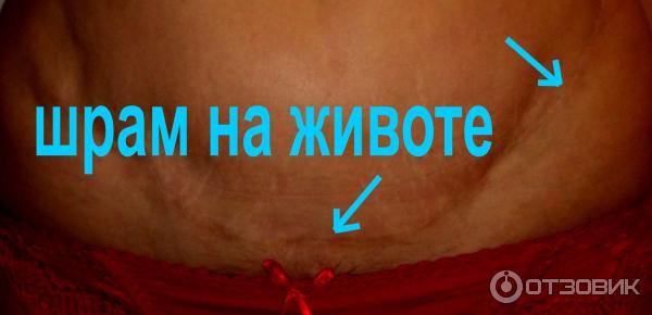 Абдоминопластика фото