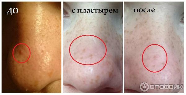 Патчи для проблемной кожи It's skin Secret solution clear patch фото