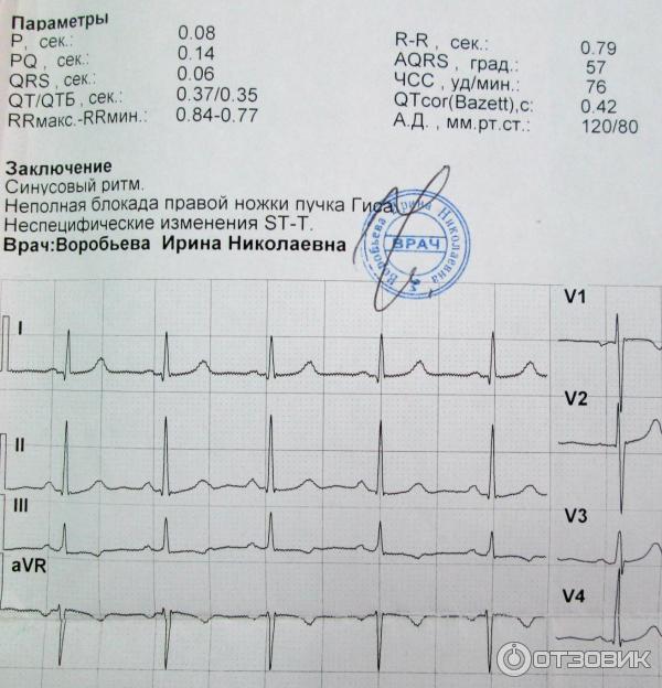 Приказ экг. Расшифровка ЭКГ показатели нормы. Кардиограмма QRS норма. Норма здорового человека показатели ЭКГ. ЭКГ 2 отведение патологии.