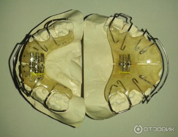 Пластинка для зубов нижняя челюсть как выглядит Отзыв о Ортодонтические пластины на зубы Leone наши первые шаги к красивой улыбк
